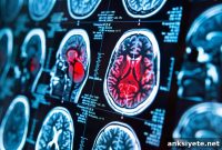 Study Finds Concussions Raise Brain Iron Levels
