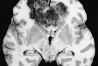Metabolic Molecule Fuels Aggressive Brain Tumor Growth