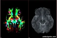 Brain Imaging Could Improve Movement Disorder Diagnosis