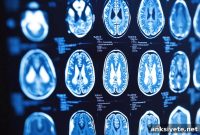 Study: ChatGPT Matches Radiologists in Brain Tumor Diagnosis