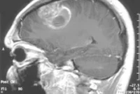 Nanoparticles Penetrate Brain to Destroy Aggressive Tumors