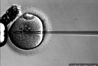 Study: IVF for Male Infertility Linked to Autism Risk in Children