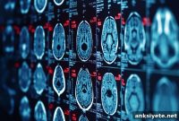 Reduced Brain Blood Flow May Signal Mild Cognitive Impairment