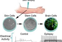 Stem Cell Models Reveal Origins and Treatment Clues for Epilepsy
