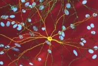 Huntington’s Disease Breakthrough: Key Clue Toward Treatment
