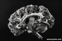 8-Minute MRI Detects Multiple Sclerosis Without Lumbar Puncture