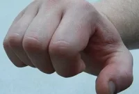 Teen Fight Injuries Linked to Lower IQ