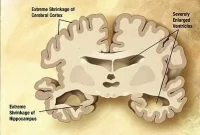 Could a Genetic Variant Explain Alzheimer’s?