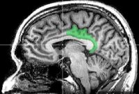 New Study Finds Brain Network Decline in Early Alzheimer’s