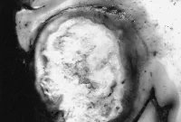 New Molecular Switch Controls Growth of Aggressive Glioblastoma