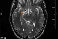 Mouse Study Eradicates Human Brain Tumor Cells