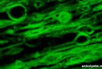 Uncovering Early Myelin Damage in Multiple Sclerosis