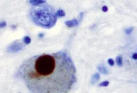 Potential Parkinson’s Biomarker Identified in New Study