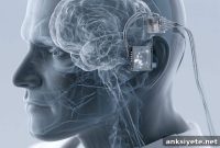 Implantable BCI Begins Clinical Trial for Advanced ALS