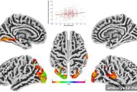 Lifetime Estrogen Exposure Linked to Less Brain Atrophy in Women