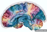 Genetics and Brain Tissue Patterns Predict MS Progression