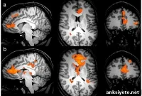 Self Reflection Increases Brain Activity in Depression