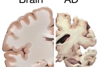 How Protein Mutations Cause Familial Alzheimer’s Disease