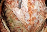 Induced Hypothermia Raises Risk in Severe Bacterial Meningitis