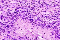 Researchers Identify New Drug Target for Brain Cancer Treatment