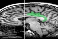 Brain Structure Predicts Pain Sensitivity