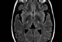 New Study Reveals How ALS Spreads in Brain and Spine