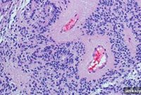 Gene Sequencing Identifies Common Driver of Childhood Brain Tumor