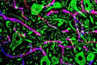 Experimental Stroke Therapy Shows Promise for ALS Patients
