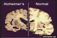 Inherited Alzheimer’s Linked to Brain Damage Decades Earlier