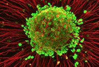 New Study Reveals Complex Origins of ALS