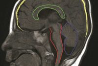Single Gene Mutation Linked to Rare Neurological Disorder