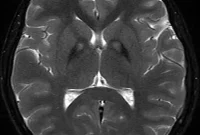 MRI Scans Detect Early Parkinson’s Disease