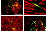 Scientists Reprogram Skin Cells to Model a Rare Disease