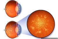 Native American Ancestry Linked to Diabetic Eye Risk in Latinos