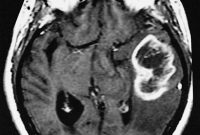 Decoding Mechanisms of Glioblastoma Treatment Resistance