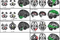 Wii Balance Board Training Alters Brain Activity in MS