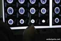 Big Data Mining Reveals New Clues to Alzheimer’s