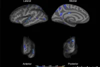 Orphanage Care Linked to Thinner Cortex in ADHD Regions