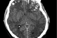 New Data Reveals How Head Injuries Occur in Kids