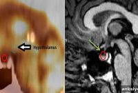 Brain MRI Reveals Pituitary Abnormalities in Veterans with PTSD
