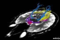 Myelin Speeds Visual Recovery After Tumor Surgery