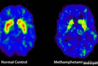 Methamphetamine Linked to Increased Parkinson’s Risk