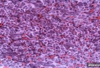 New Study Reveals How Childhood Brain Tumors Relapse