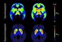 Obesity Linked to Lower Brain Opioid Receptor Availability