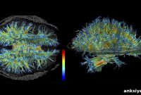 Severe Schizophrenia Shows Distinct Brain Network Patterns