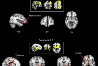 Autism Brain Development: Age-Specific Changes Explained