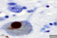 New Tool Reveals Insights into Parkinson’s Disease