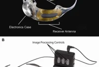 Bionic Eye Implant Restores Vision and Enhances Daily Life