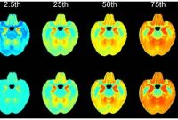 New Digital Brain Atlas Could Improve Alzheimer’s Diagnosis