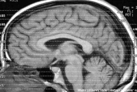 Common Medications That Slow Recovery After Brain Injury